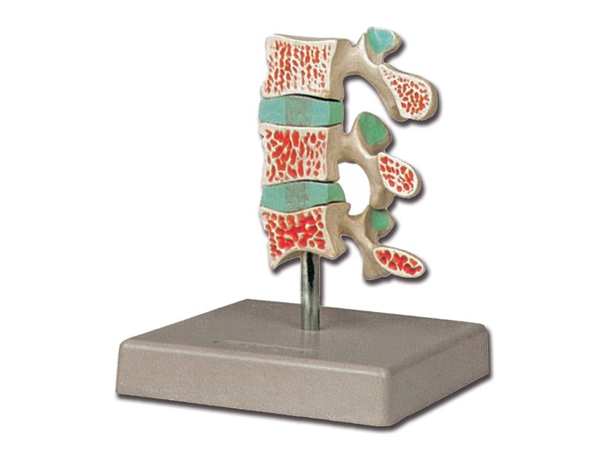 OSTEOPOROSIS MODEL