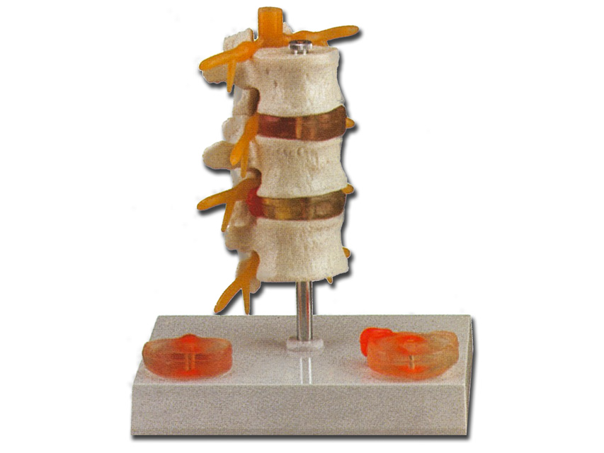 [40180] HERNIA PATHOLOGY MODEL