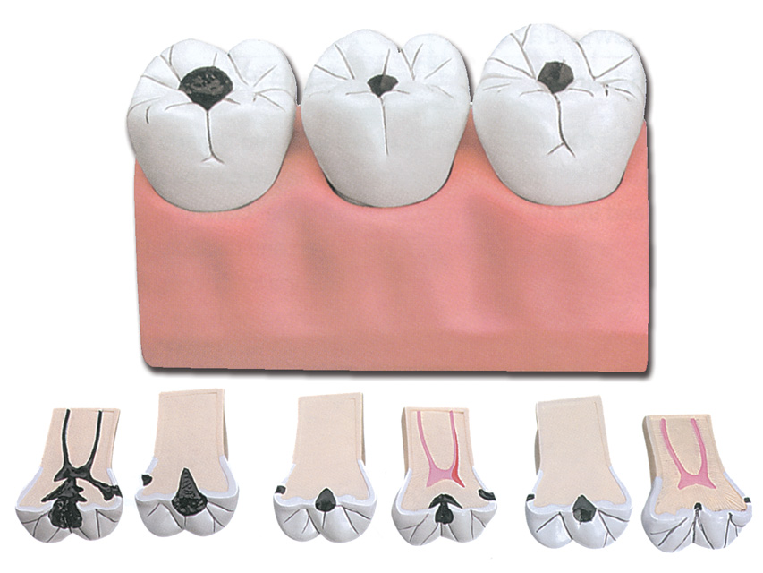 [40211] CARIES MODEL