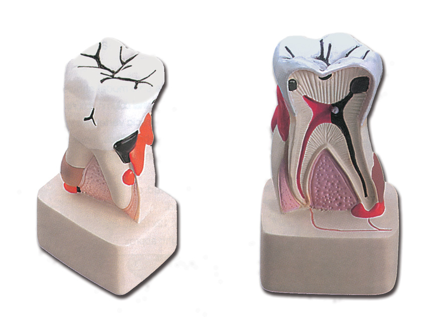 [40212] DENTAL PATHOLOGY MODEL