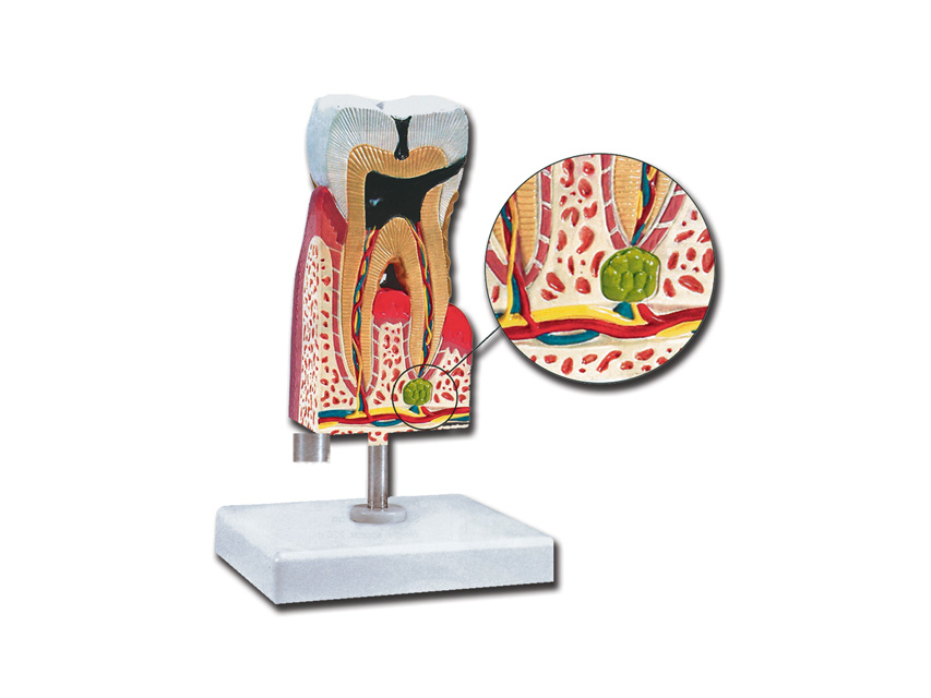 [40214] LOWER MOLAR WITH CARIES